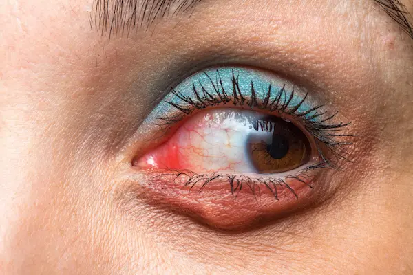 Traitement du chalazion et chirurgie des paupières à Paris 8 — Dr Lussato