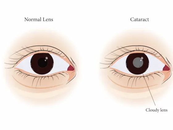 Operation de la cataracte : chirurgie et implants - Paris