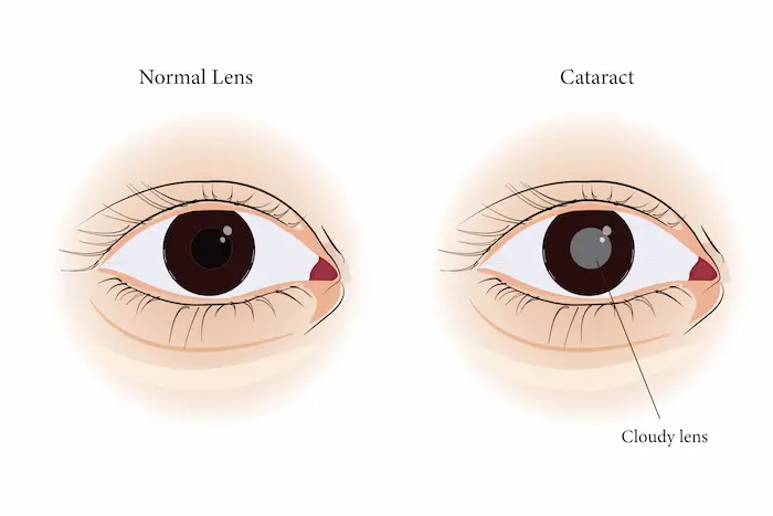Operation de la cataracte : chirurgie et implants - Paris