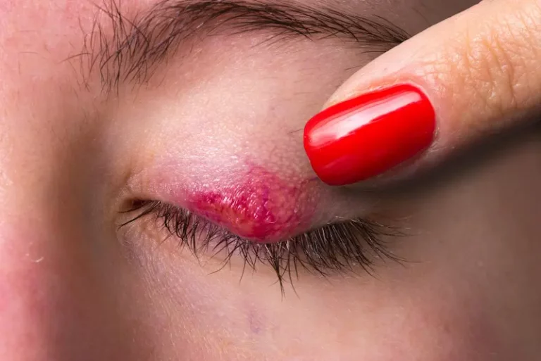 Chalazion sur la paupiere : traitement par un ophtalmologue a Paris