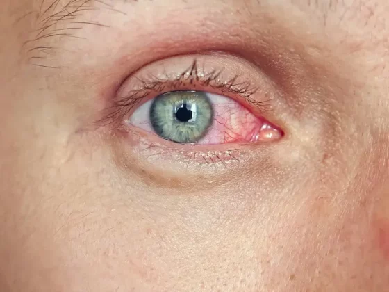 Glaucome : dépistage et suivi | Ophtalmologue Paris 8