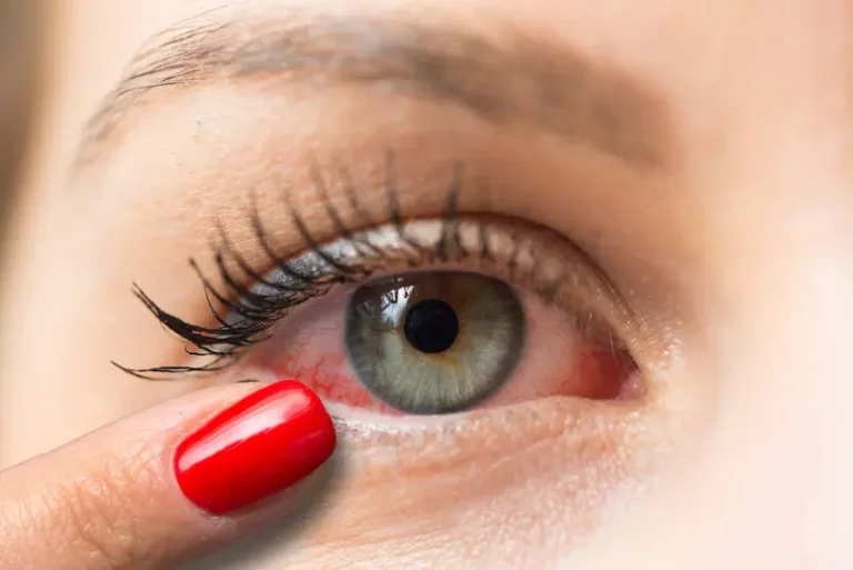 Œil rouge : causes et quand consulter