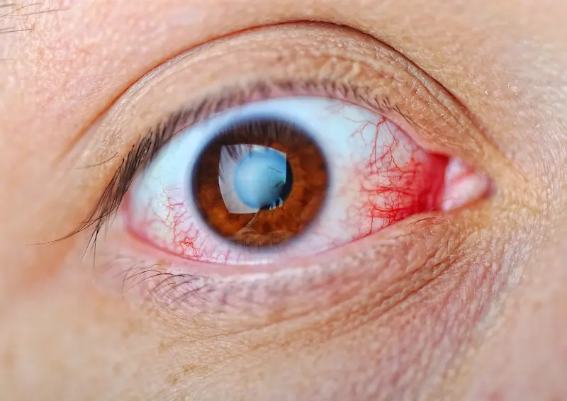 Œil rouge : causes et quand consulter